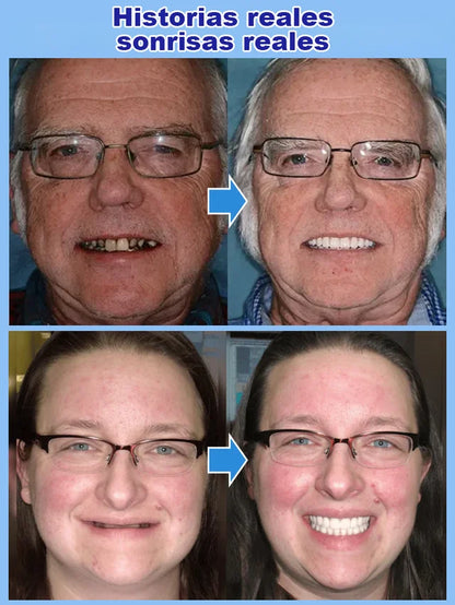 Set de prótesis dentales de soporte esquelético total